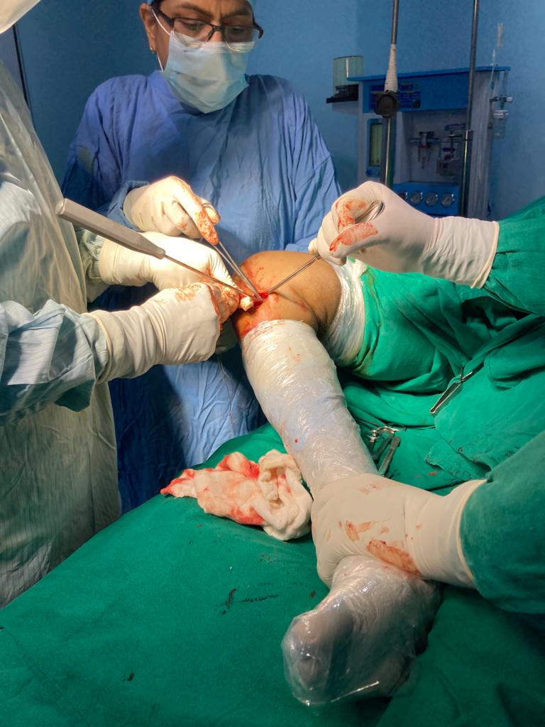 HAMSTRING GRAFT FOR ACL 